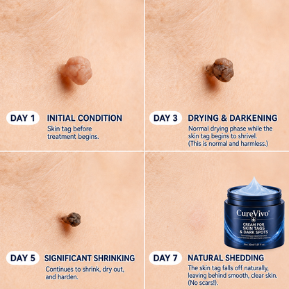 👍𝗖𝘂𝗿𝗲𝗩𝗶𝘃𝗼® 𝟕-𝐃𝐚𝐲 𝐒𝐤𝐢𝐧 𝐓𝐚𝐠 & 𝐒𝐩𝐨𝐭 𝐑𝐞𝐦𝐨𝐯𝐚𝐥 𝐂𝐫𝐞𝐚𝐦 (𝐏𝐚𝐢𝐧𝐥𝐞𝐬𝐬 𝐅𝐨𝐫𝐦𝐮𝐥𝐚 – 𝐍𝐨 𝐒𝐜𝐚𝐫𝐬)
