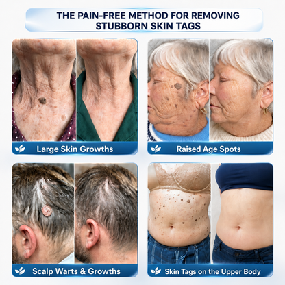 👍𝗖𝘂𝗿𝗲𝗩𝗶𝘃𝗼® 𝟕-𝐃𝐚𝐲 𝐒𝐤𝐢𝐧 𝐓𝐚𝐠 & 𝐒𝐩𝐨𝐭 𝐑𝐞𝐦𝐨𝐯𝐚𝐥 𝐂𝐫𝐞𝐚𝐦 (𝐏𝐚𝐢𝐧𝐥𝐞𝐬𝐬 𝐅𝐨𝐫𝐦𝐮𝐥𝐚 – 𝐍𝐨 𝐒𝐜𝐚𝐫𝐬)