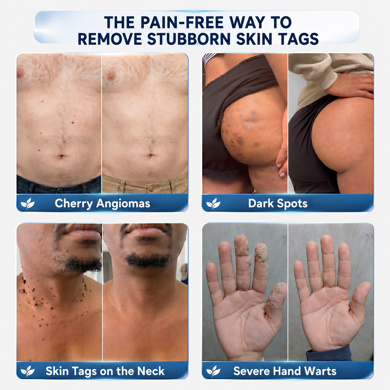 👍𝗖𝘂𝗿𝗲𝗩𝗶𝘃𝗼® 𝟕-𝐃𝐚𝐲 𝐒𝐤𝐢𝐧 𝐓𝐚𝐠 & 𝐒𝐩𝐨𝐭 𝐑𝐞𝐦𝐨𝐯𝐚𝐥 𝐂𝐫𝐞𝐚𝐦 (𝐏𝐚𝐢𝐧𝐥𝐞𝐬𝐬 𝐅𝐨𝐫𝐦𝐮𝐥𝐚 – 𝐍𝐨 𝐒𝐜𝐚𝐫𝐬)