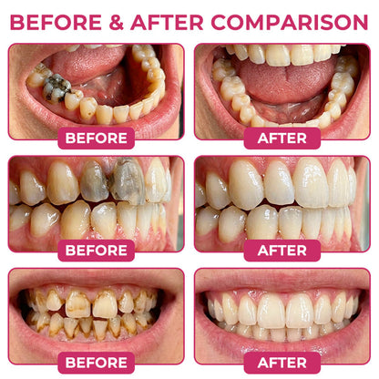 🇦🇺🦷👩‍⚕️CureViVo® DenPerm Cavity-Repair Natural Enamel Filling Gel👍