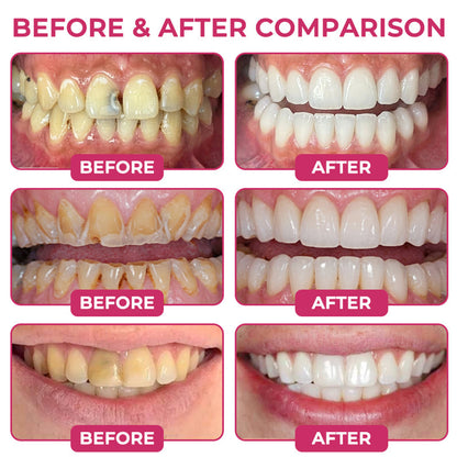 🇦🇺🦷👩‍⚕️CureViVo® DenPerm Cavity-Repair Natural Enamel Filling Gel👍