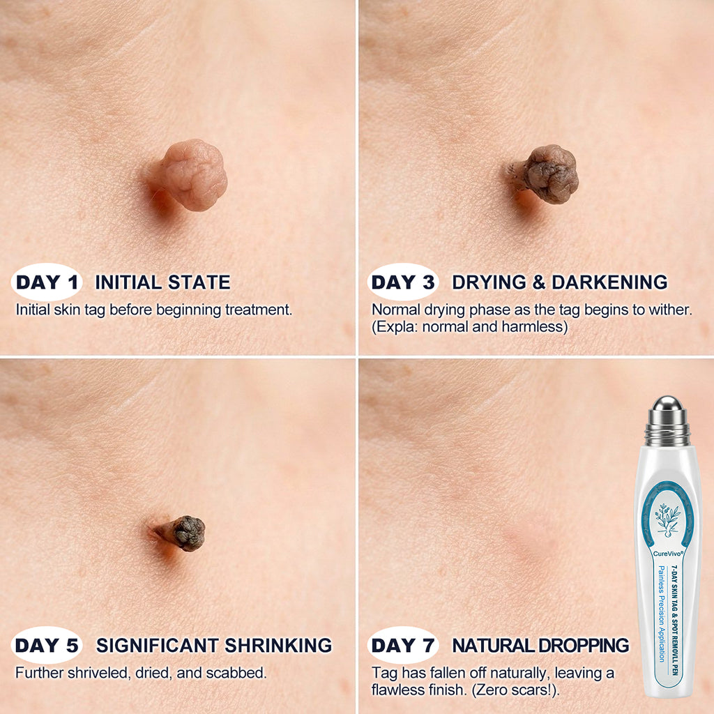 🇦🇺👩‍⚕️👍CureVivo® 7-𝐷𝑎𝑦 𝗧𝐚𝐠 & 𝗦𝗽𝐨𝐭 𝐄𝐫𝒂𝒔𝒆𝒓✅🎁(Zero Pain, Zero 𝐒𝐜𝐚𝒓𝒔 Rollerball)