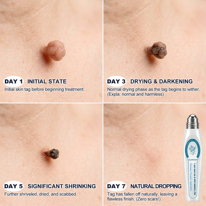🇦🇺👩‍⚕️👍CureVivo® 7-𝐷𝑎𝑦 𝗧𝐚𝐠 & 𝗦𝗽𝐨𝐭 𝐄𝐫𝒂𝒔𝒆𝒓✅🎁(Zero Pain, Zero 𝐒𝐜𝐚𝒓𝒔 Rollerball)